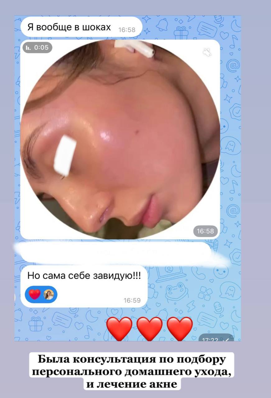 Скриншот отзыва пациента о консультации по подбору домашнего ухода и лечении акне